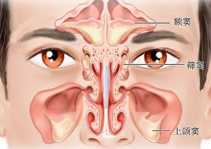 鼻窦炎不仅能造成鼻窦炎性支气管炎,还有可能阻塞与
